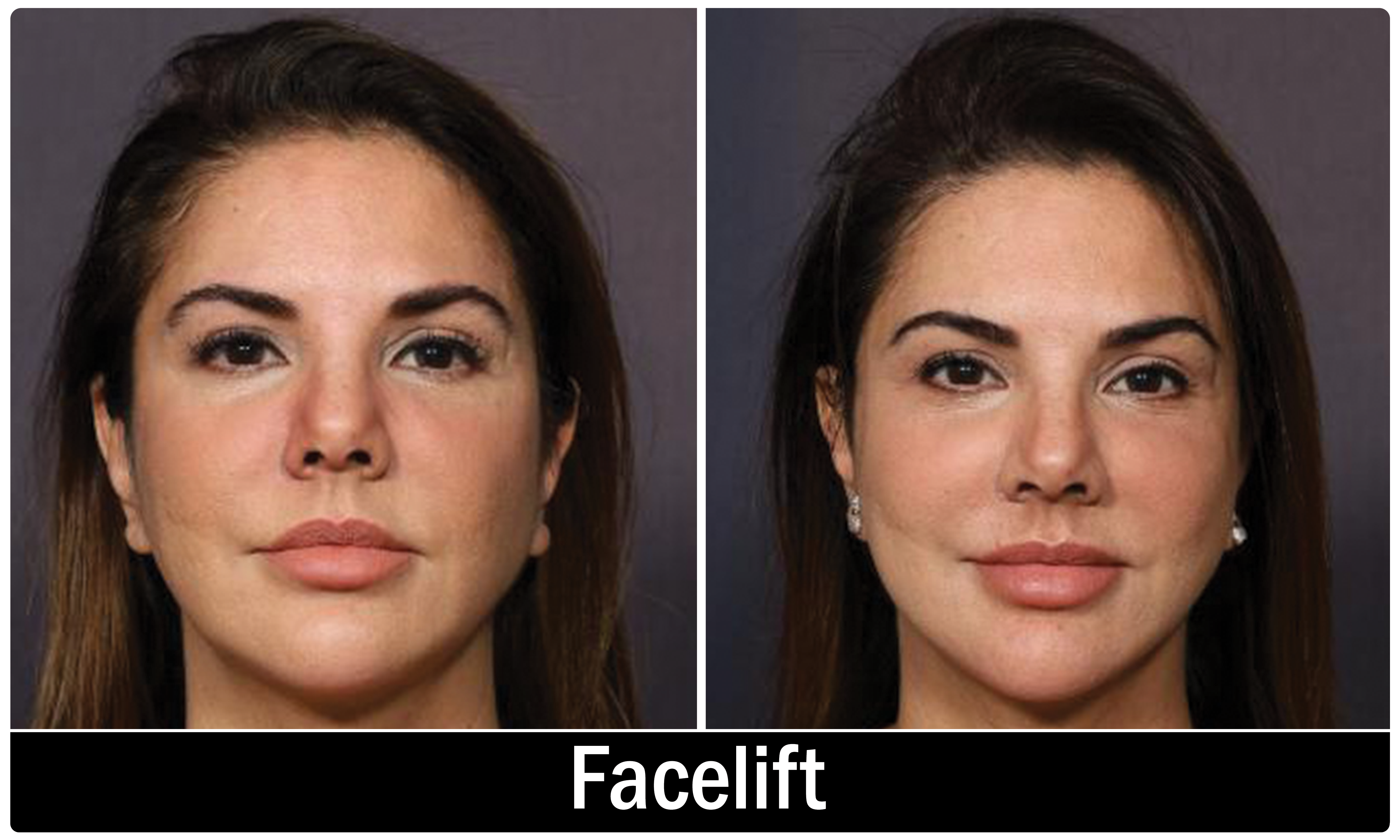 Facelift result KOQ10